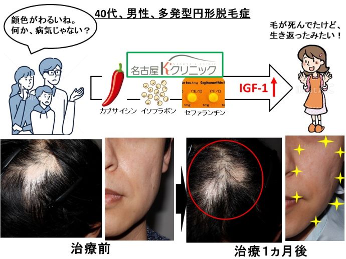 円形脱毛症　病院